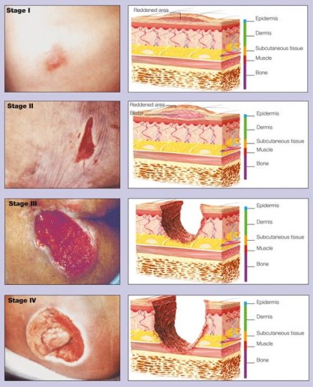 Ade Nutrition In Wound Healing For Adults With Diabetes A Practice Update