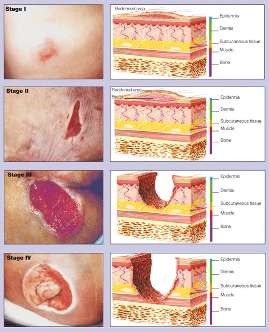 Wound Care: How to Care for an Open Wound or Cut